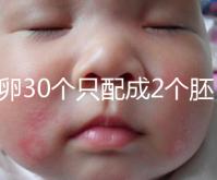 取卵30個(gè)只配成2個(gè)胚胎別放棄！卵巢傷口小移植成功率不低