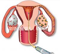 助孕試管嬰兒(助孕試管嬰兒保險(xiǎn))