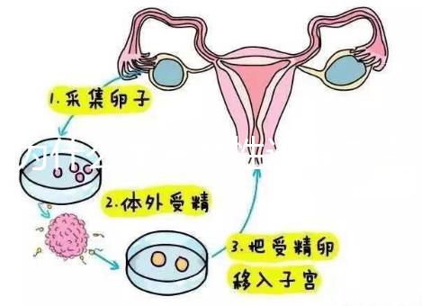 為什么單身女性選擇烏克蘭MINI醫院試管嬰兒?詳細分析三個原因