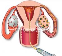 一代二代三代試管嬰兒有什么區別