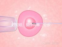 時(shí)間短、操作簡(jiǎn)單,分步驟解讀宮頸擴(kuò)張術(shù)全過(guò)程