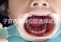 子宮內(nèi)膜異位癥選擇試管嬰兒有3大理由,成功率是其一