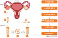 女扎后能做試管嬰兒嗎(45歲結扎了還能做試管嬰兒嗎)