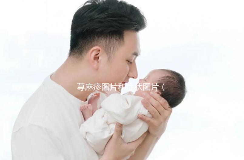 蕁麻疹圖片和癥狀圖片(蕁麻疹圖片和癥狀圖片怎么辦)