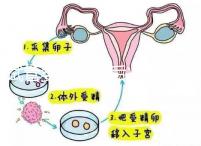 試管嬰兒二超后減藥原因已找到，對胎兒沒影響別瞎擔心
