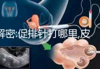 解密:促排針打哪里,皮下