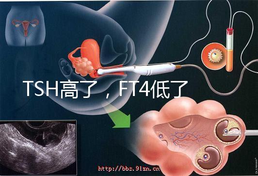 TSH高了，F(xiàn)T4低了，需要補(bǔ)碘嗎？